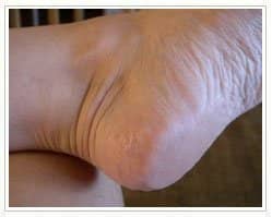 Slider image (7) Laser Foot Surgery Specialist